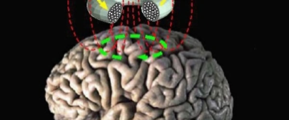 Transcranial magnetic stimulation